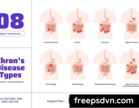 Chron’s Disease – Human Body Organ Treatment LGYL2FZ Chrons Disease Human Body Organ Treatment LGYL2FZ 0