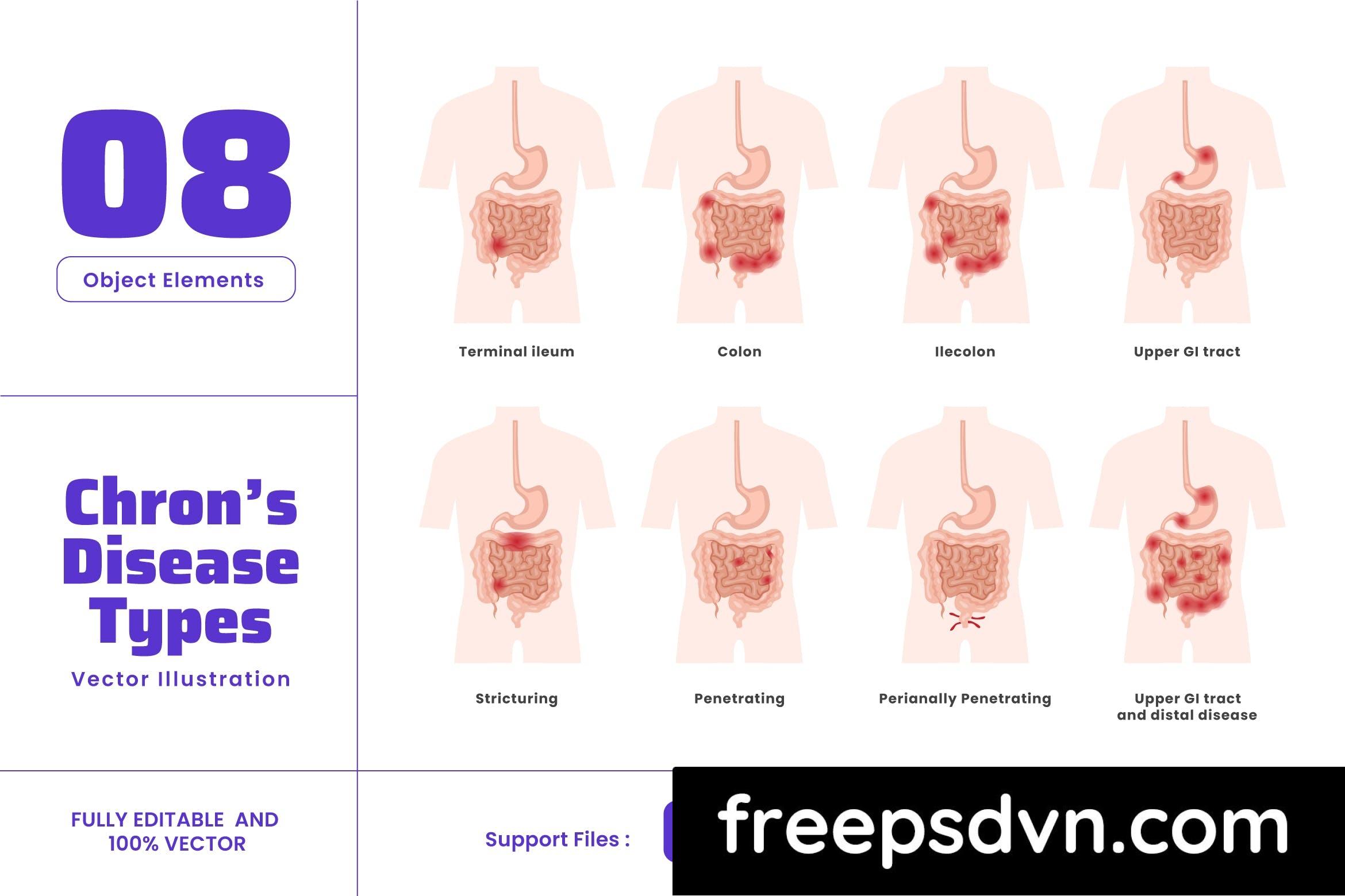 chrons disease human body organ treatment lgyl2fz 0 1